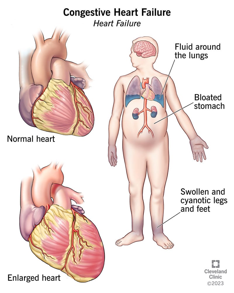 what-is-congestive-heart-failure-stages-causes-signs-symptoms