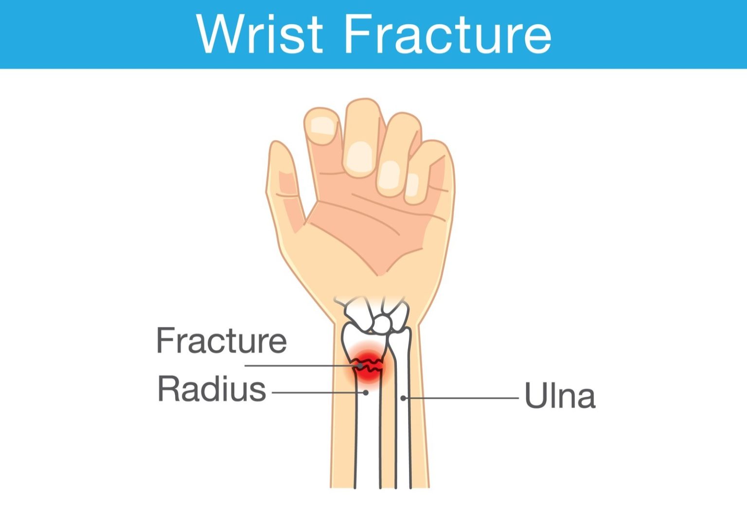 Dislocated Wrist: Understanding Symptoms and Treatment Options - Bloomsies