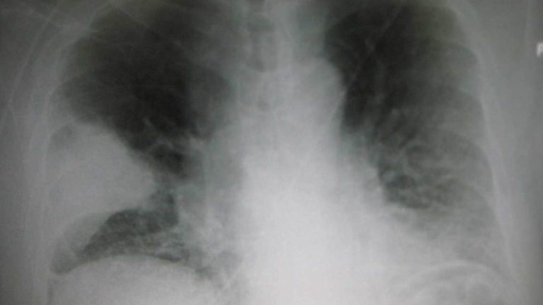 lung-v-q-scan