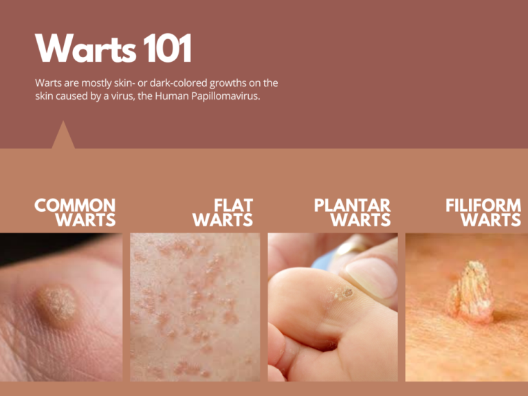 mosaic-warts-101-understanding-this-common-skin-condition-bloomsies