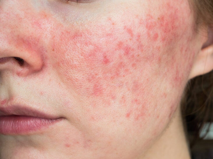 Rosacea vs Lupus Rash: Key Differences You Need to Know - Bloomsies