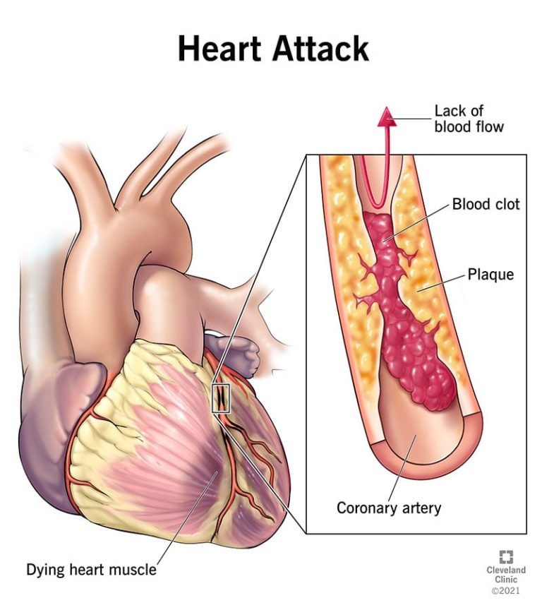 septal-infarct-causes-symptoms-and-treatment-options-bloomsies