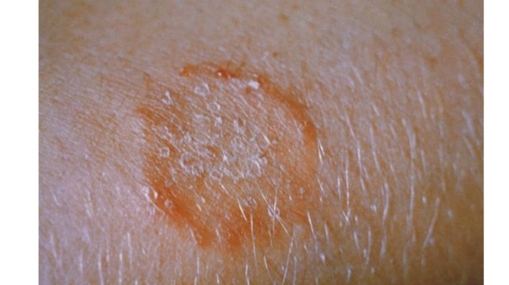 Spongiotic Dermatitis: Causes, Symptoms and Treatment - Bloomsies