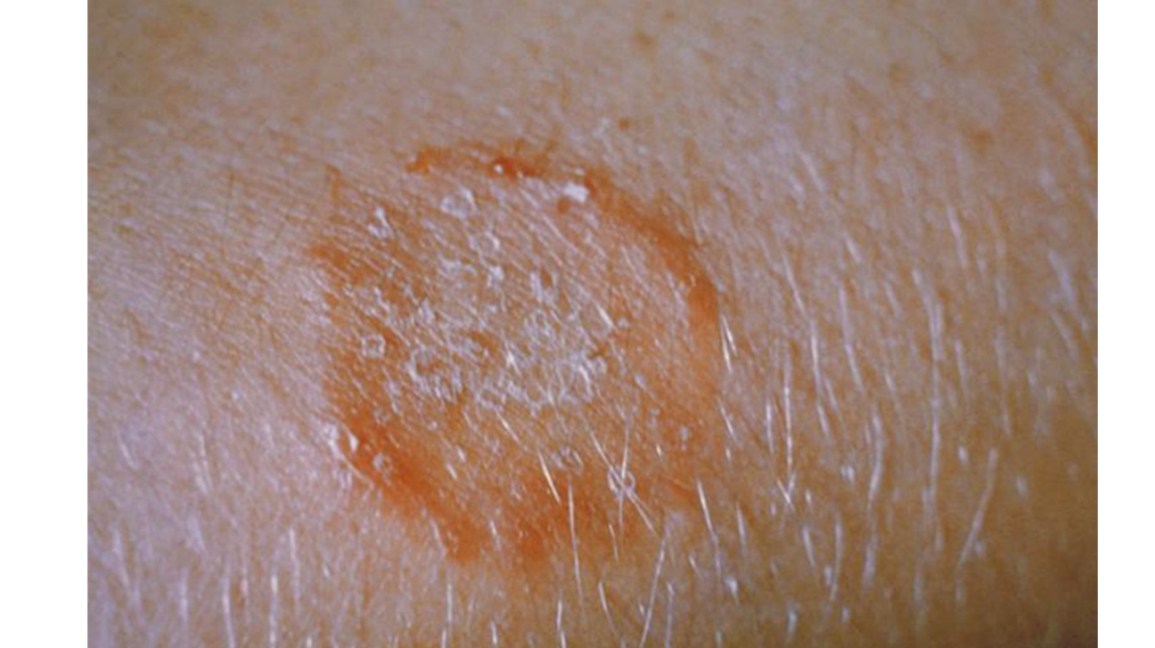 Spongiotic Dermatitis Causes, Symptoms and Treatment Bloomsies