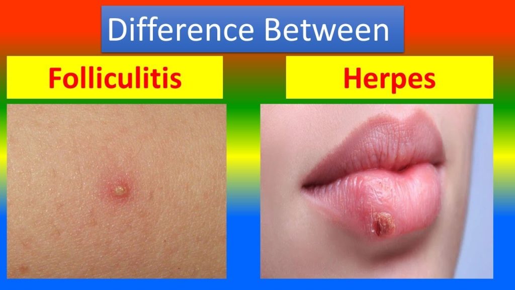 Herpes vs. Folliculitis Key Differences to Know Bloomsies