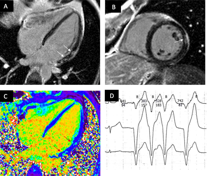 Recurrent Ventricular Tachycardia Due to Myotonic Dystrophy Type II ...