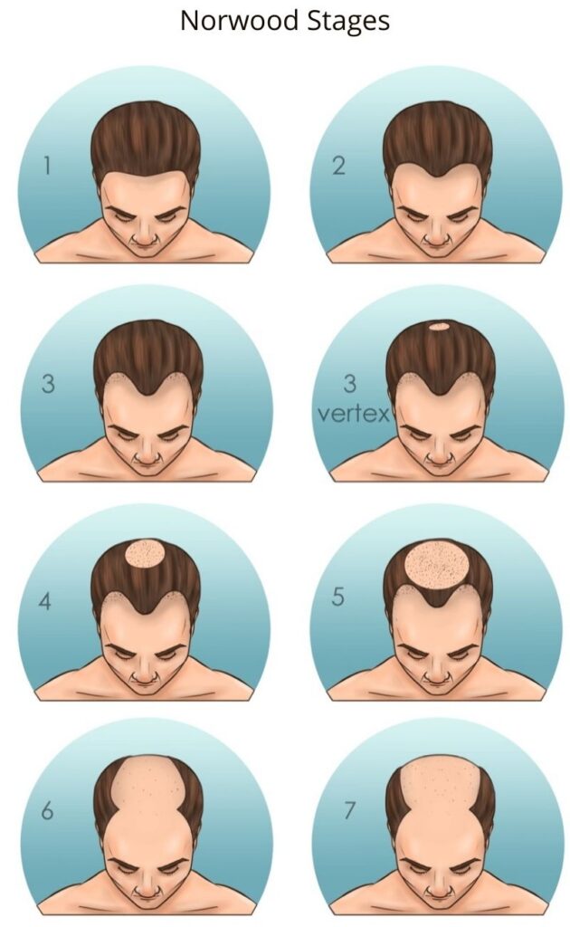 Signs of Receding Hairline: Understanding the Early Stages - Bloomsies