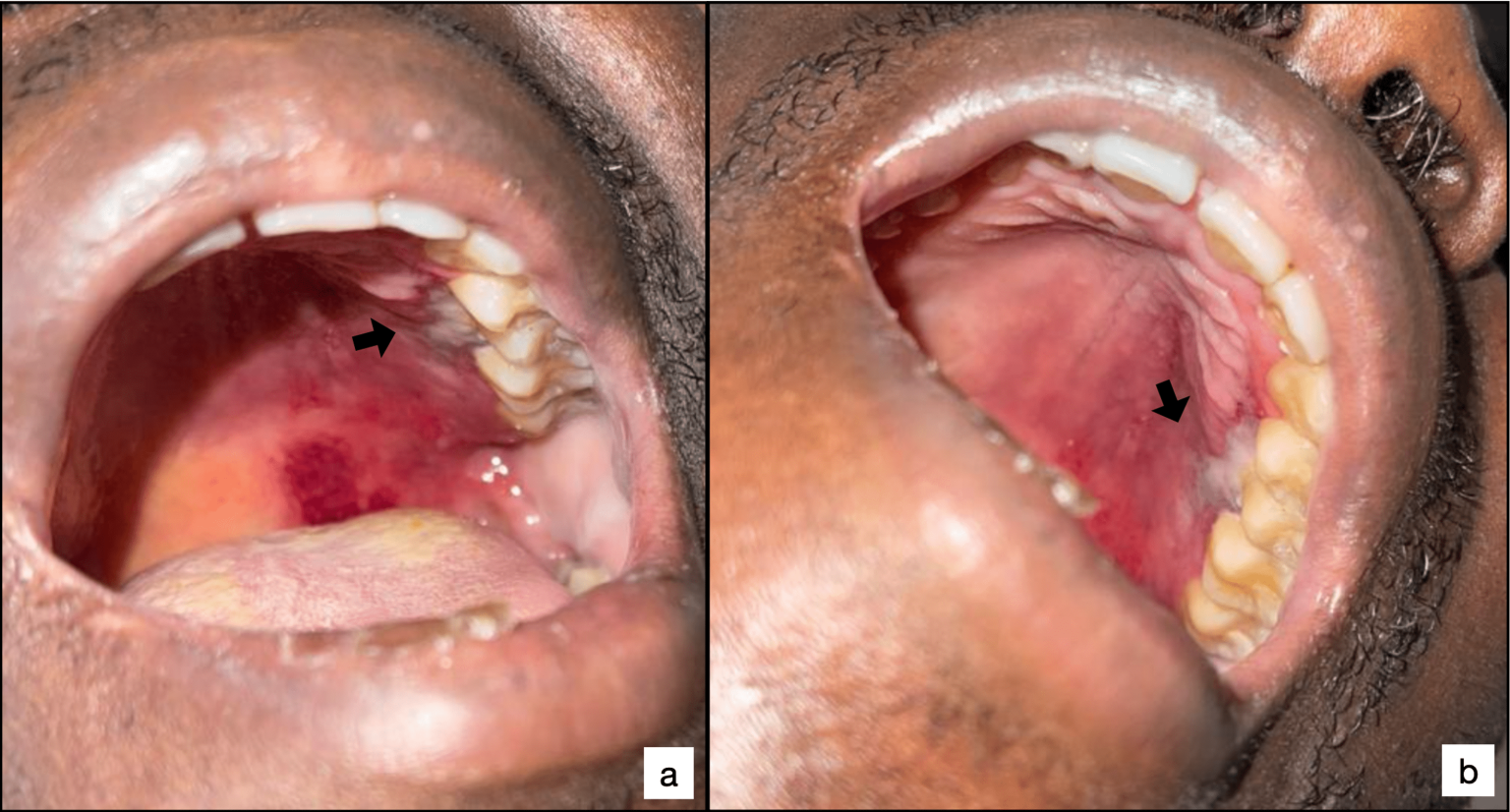 palatal-petechiae-causes-symptoms-and-treatment-options-bloomsies