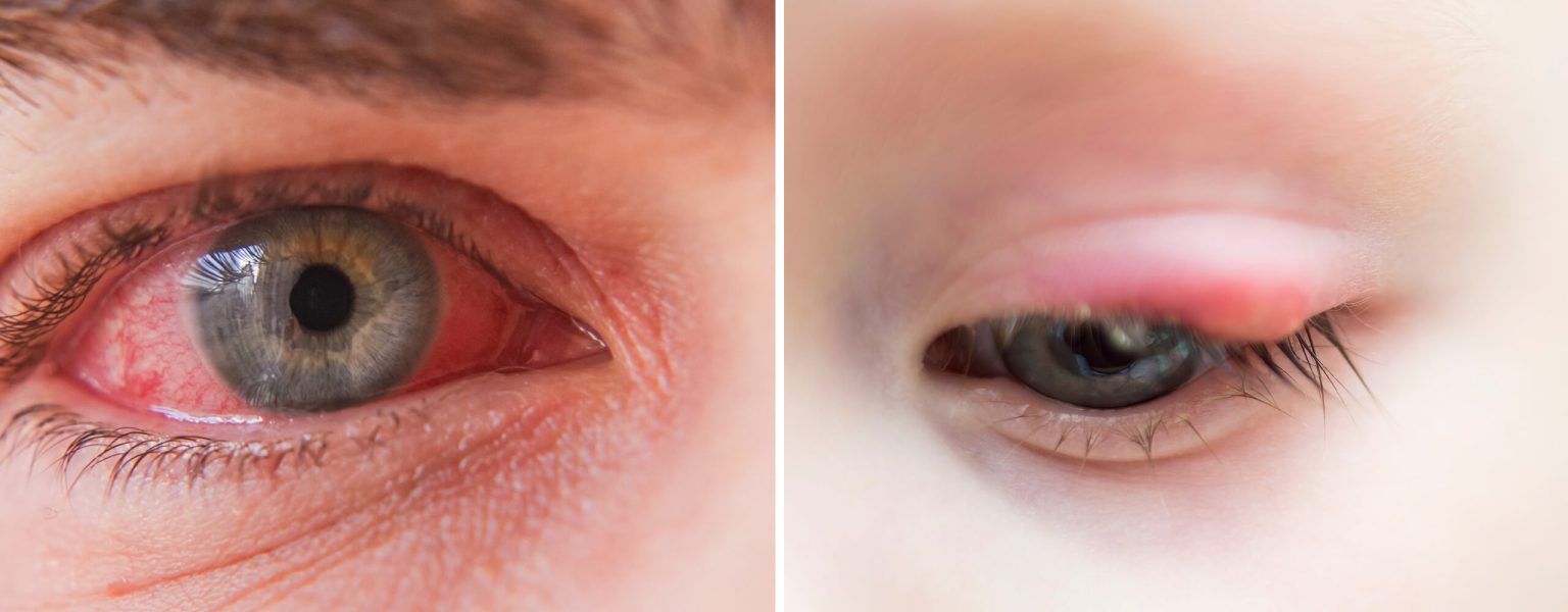 Pink Eye vs. Stye What's the Difference? Bloomsies