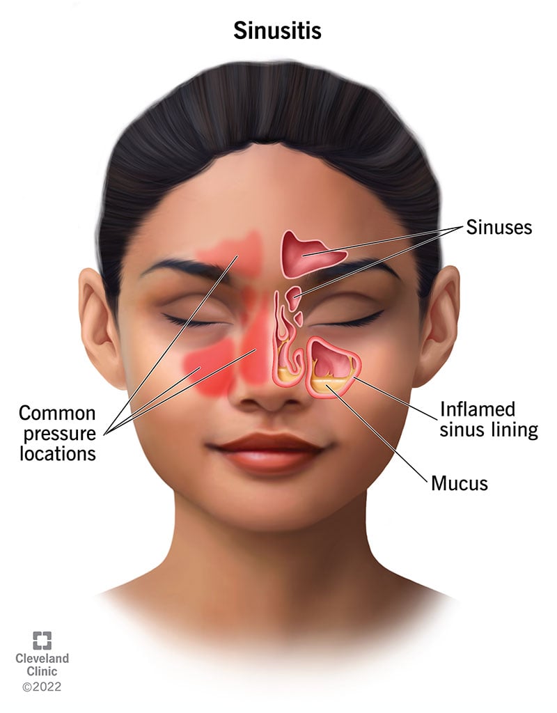 blocked-sinus-inflicting-eye-ache