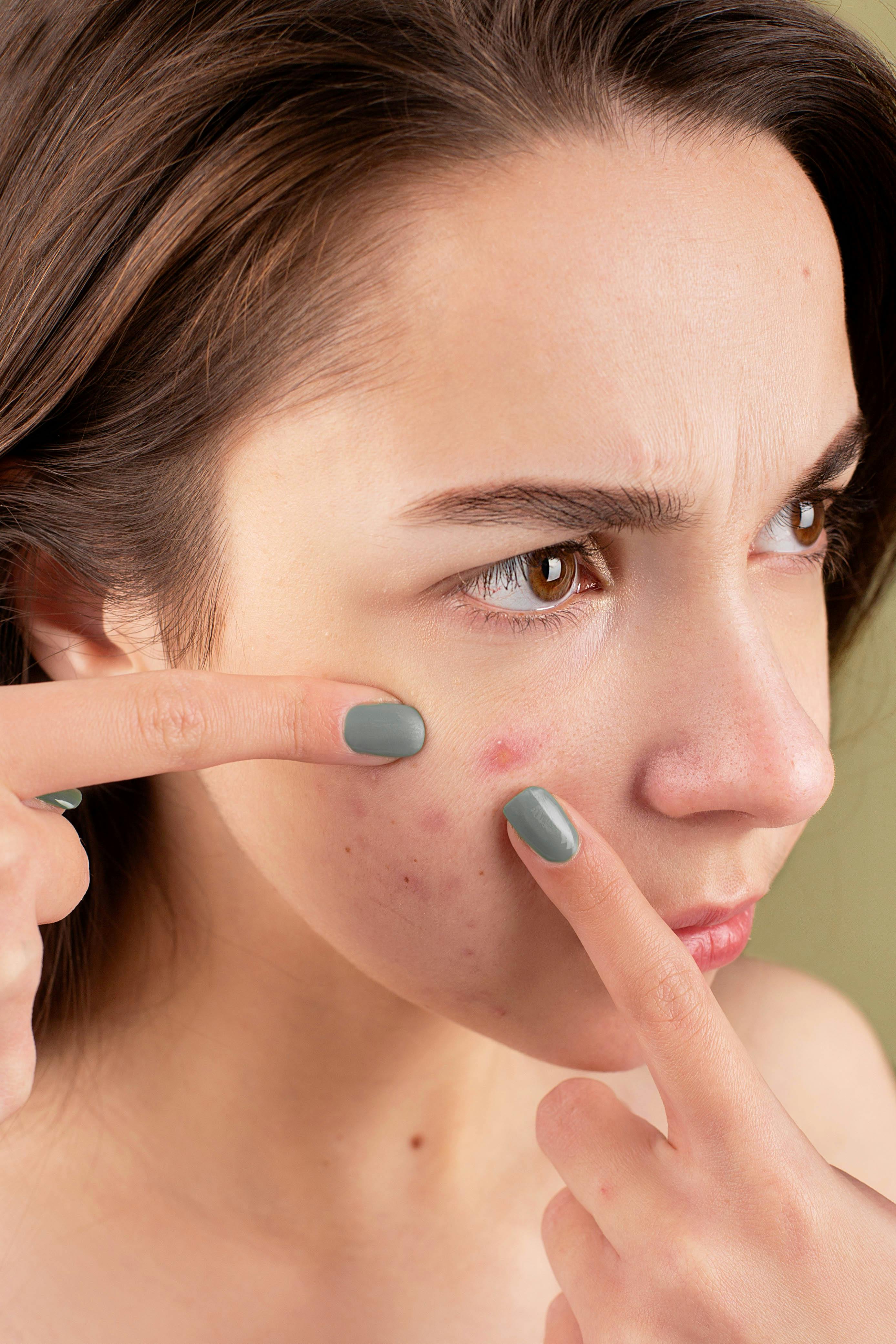 Close-up of a young woman treating her acne-prone skin.